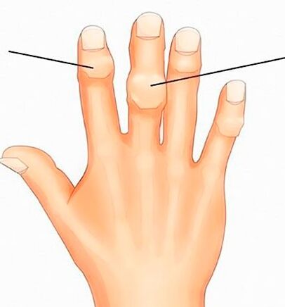 Heberdenovi i Bouchardovi čvorovi na interfalangealnim zglobovima s artrozom