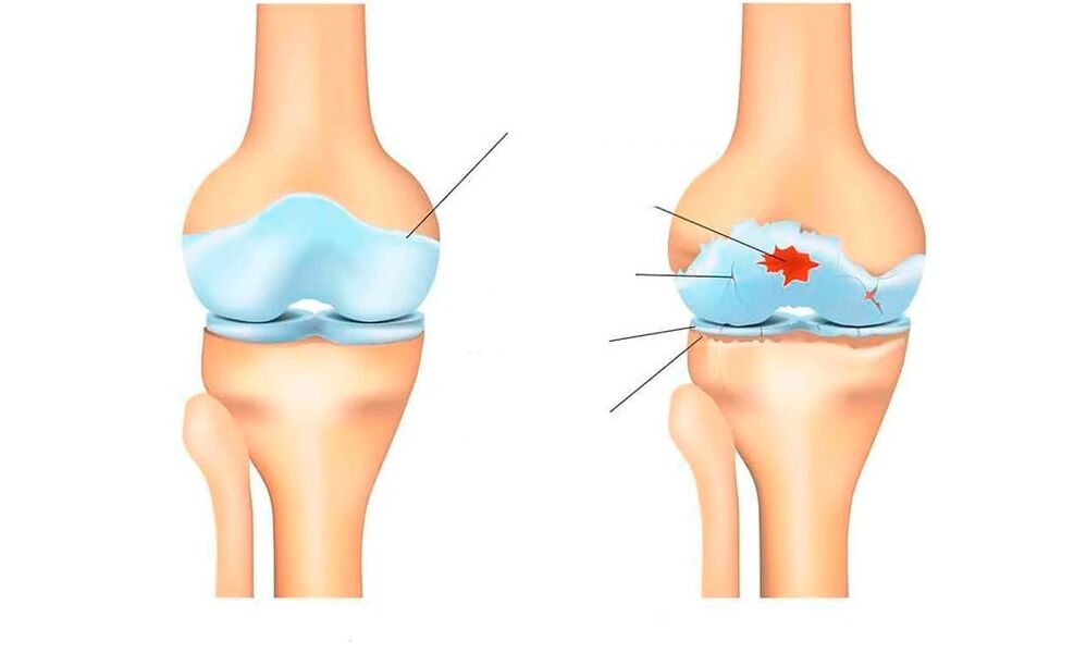 zdravog zgloba i kod artroze