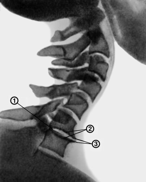 X-zraka vratne kralježnice s osteohondrozom